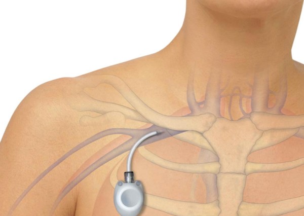 Imagem do procedimento Implante de cateter para Quimioterapia (PORTOCATH)